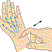 تست تینل (Tinel’s test)