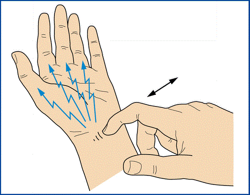 تست تینل (Tinel’s test)