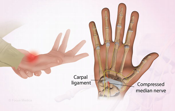 درد مچ دست و کف دست سندروم کارپال تانل (Carpal Tunnel Syndrome