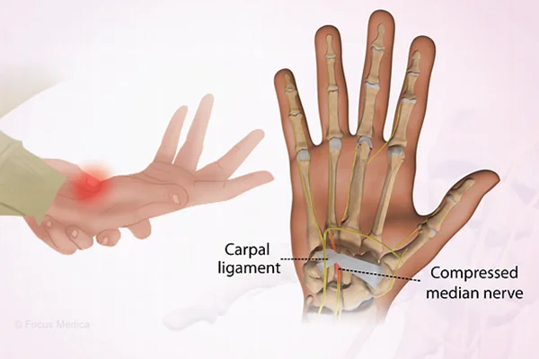درد مچ دست و کف دست سندروم کارپال تانل (Carpal Tunnel Syndrome