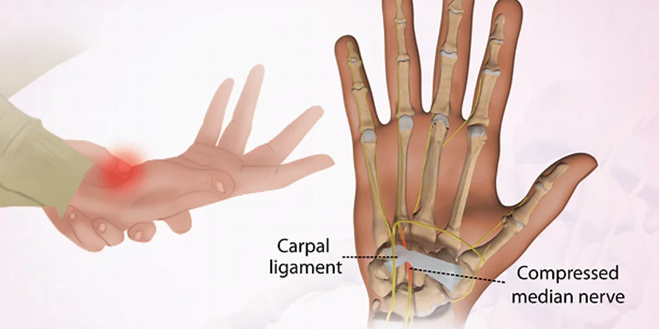درد مچ دست و کف دست سندروم کارپال تانل (Carpal Tunnel Syndrome